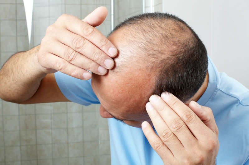 How Hair Transplants can Help CT Residents