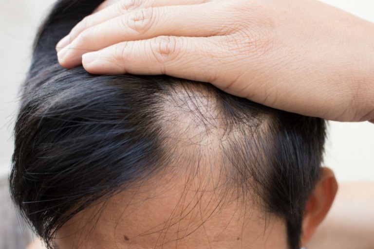 Hair Transplant: What to Expect After the Surgery