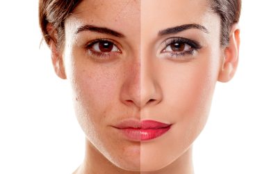 Transform your look with skin tightening in Tomball TX for firmer and more youthful skin
